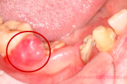牙齿里面长肿瘤是怎么回事，该如何治疗?