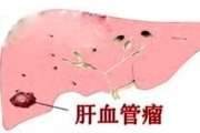 加入肝部血管瘤交流群，获取最新资讯！