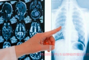 肺腺癌术后恢复期：出现白色泡沫痰，是否需要担心术后感染？