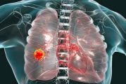 肺癌病人交流群,肺癌患者骨转移症状