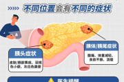 胰腺癌交流解答群：胰腺癌为什么是癌王