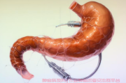 胃镜检查发现食管溃疡，怀疑食管癌该怎么办？