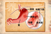 胃溃疡就是胃癌吗？胃溃疡与胃癌重要的关联揭秘