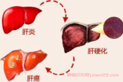 肝癌恶性肿瘤怎么预防转移?为何肝癌如此高发