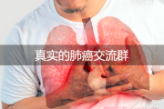 真实的肺癌交流群加入，肺癌交流群之光