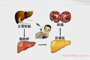 肝癌中晚期患者群,肝癌中晚期患者的故事