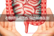 为什么升结肠癌容易贫血的原因,升结肠癌导致贫血的四大机制