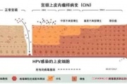 cin病变是什么严重吗，cin3是宫颈癌吗?