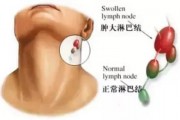 肿瘤扩散和癌症转移的症状及防治