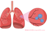 体检发现肺部实性结节1厘米怎么办？肺结节群医生解答