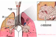 加入小细胞群肺癌：勇气与希望