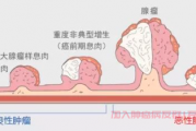 肿瘤群答疑,出现肠息肉会演变成肠癌吗？