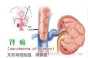 肾癌吃靶向药一直脚疼血压高是怎么回事？