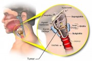 喉癌有什么异常症状，饮食注意什么？