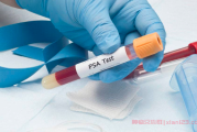 前列腺癌群聊问答：前列腺癌全切后PSA0.6正常吗？