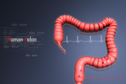 探索生命的隐秘角落——揭开结肠肿瘤群体的面纱