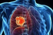 全国肺癌病友群解答，肺癌放疗后一直咳嗽如何缓解？