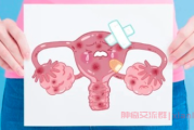 宫颈癌群聊问答：宫颈癌4期B级扩散到淋巴化疗吃不消怎么办？