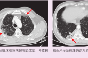 肺纤维化是肺癌吗?解读两种截然不同的疾病