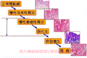 抗胃癌成功交流群答疑,上腹部疼痛查出胃癌能否治愈？