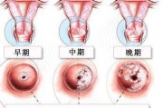 宫颈癌的癌前病变是怎么样的？