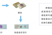 如何诊断恶性淋巴瘤？淋巴瘤分期有哪些？