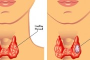 甲状腺癌患者术后需要注意什么，如何检查？