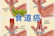 食管癌是什么，食管癌病因？该如何预防?