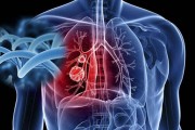肺腺癌晚期95%能活多久？看完你就明白了