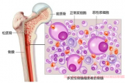 多发性骨髓瘤治疗需要花费多少钱？