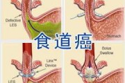 食道癌交流群：食道癌晚期能活多久？