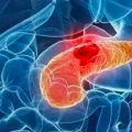 胰腺肿瘤群：胰腺癌能治好吗，早晚期胰腺癌区别