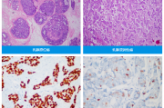 乳腺癌病理报告怎么看,病理检验诊断有哪些
