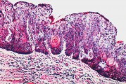 早期食管癌与贲门肿瘤病理类型