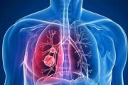 肺癌的筛查和预防方法