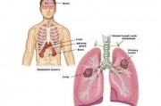 肺癌转移会引起哪些症状?