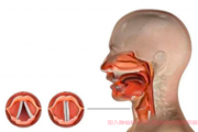 喉癌的早期症状及表现,确诊后如何治疗？