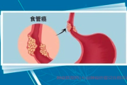 肺炎对食管癌患者的影响及治疗建议