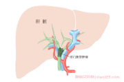 肝门胆管肿瘤算是肝癌吗?了解肝癌的不同形式
