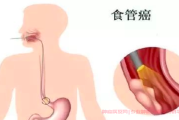 食管癌病理类型和分化程度对治疗效果的影响