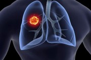 小细胞肺癌SCLC治疗有哪些？如何治疗？