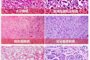 乳腺癌诊疗指南：浸润性乳腺癌常见类型介绍/组织学类型/分子分型