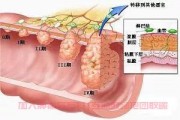 肠癌群加入,直肠癌手术能保留肛门吗,保留肛门条件？