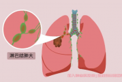 肺腺癌群微信群信息,淋巴结增大严重吗？