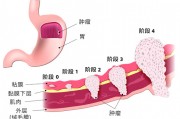 胃癌的筛查建议和预防方法
