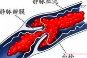 晚期肺癌治疗方案选择：化疗后血栓应对策略解析