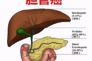 什么是胆道肿瘤，肿瘤靶向治疗的特征与优势