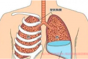 肺癌晚期胸腔积液没有了,经常发烧是复发吗？