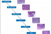 胃癌最“爱”这几类人