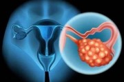 卵巢癌的确诊需要做哪些检查？